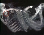Die Röntgenaufnahme beweist, dass 'Ötzi' von hinten in die linke Schulter getroffen wurde.